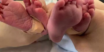 В Ірландії жінка, яка не помітила власну вагітність, народила двійню