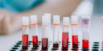 Хворобу Паркінсона ще до до появи симптомів може виявити новий аналіз крові – вчені