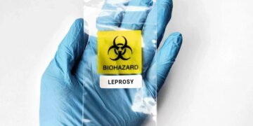 В Европе выявили проказу: средневековое заболевание обнаружили у границ с Украиной